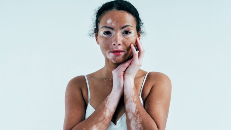 Vitilinox: A chronic autoimmune skin condition Vitilinox: A chronic autoimmune skin condition